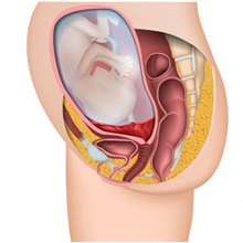 Qu'est ce que le placenta praevia ?